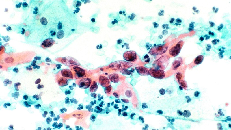 Pap smear specimen